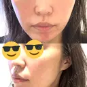 RF（高周波）たるみ治療 / オリジオ muni skin clinic BEFORE サムネイル用