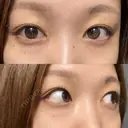 下まぶたの脂肪取り / 眉下切開 / ボトックス（額） 表参道ウィズ・クリニック BEFORE サムネイル用