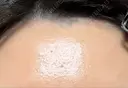 医療脱毛（顔） Jスキンクリニック 【J-SKIN clinic】 BEFORE サムネイル用