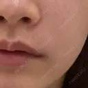 ヒアルロン酸溶解 EOL CLINIC【オルクリニック】 BEFORE サムネイル用