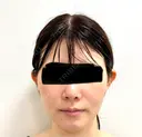糸リフト / 脂肪吸引（顔） / 輪郭修正 / ジョールファット除去 / 脂肪吸引注射（顔） SEA CLINIC（シークリニック） BEFORE サムネイル用