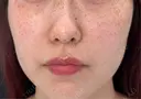 イオン導入 / ピーリング（ハリ・ツヤ） / ルメッカ ルラ美容クリニック 福岡天神院 BEFORE サムネイル用