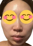 医療脱毛（顔） ルラライト美容クリニック 八王子院 BEFORE サムネイル用