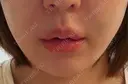 ヒアルロン酸注入（あご） / ヒアルロン酸注入（唇） 麻布十番クレールデンタルクリニック BEFORE サムネイル用