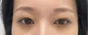 二重埋没 ルラ美容クリニック 渋谷本院 BEFORE サムネイル用