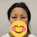 クマ治療 アリエル美容クリニック 横浜院 BEFORE サムネイル用