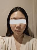 糸リフト / 脂肪吸引（顔） / メーラーファット除去 / 脂肪吸引注射（顔） SEA CLINIC（シークリニック） BEFORE サムネイル用