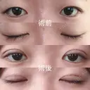 二重埋没 ルラ美容クリニック 札幌本院 BEFORE サムネイル用