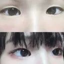 その他（目元） ばん皮膚科 BEFORE サムネイル用