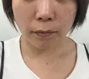 シワ取りボトックス / 肌育注射（ジュベルックなど） / ピコレーザートーニング（美白・肝斑） / ピコスポット 東京シルククリニック 新宿院 BEFORE サムネイル用