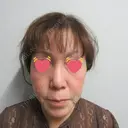 肌ヒアルロン酸注入（たるみ・シワ改善） ジョウクリニック 姫路院 BEFORE サムネイル用