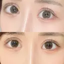 ヒアルロン酸注入（涙袋） HAAB×DREAM BEAUTY CLINIC 東京本院 BEFORE サムネイル用