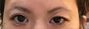 二重切開 / その他（目元） RG整形外科（旧リオン整形外科） BEFORE サムネイル用