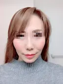 その他（目元） / クマ治療 / 額を丸く / その他（輪郭） / 下まぶたの脂肪取り / 脂肪注入（肌） / こめかみ形成 / 脂肪注入（額） / ヒアルロン酸注入（涙袋） / 脂肪注入（輪郭） / PRP皮膚再生療法 ジュエリー美容外科 BEFORE サムネイル用