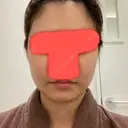 脂肪吸引（顔） / ボトックス（エラ・小顔） / 美容点滴・美容注射（美肌） エートップ美容整形外科 BEFORE サムネイル用