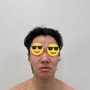 糸リフト / 脂肪吸引（顔） / メーラーファット除去 / ジョールファット除去 / 脂肪吸引注射（顔） SEA CLINIC（シークリニック） BEFORE サムネイル用