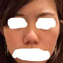小鼻縮小（切開） / スレッドノーズ / ヒアルロン酸注入（鼻） キップン整形外科 BEFORE サムネイル用