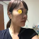 糸リフト / 骨切り（あご） / 骨削り（エラ） / 骨削り（頬） / 脂肪吸引（顔） / 輪郭修正 / 脂肪注入（額） / 脂肪注入（輪郭） / ハイフ（顔） GIRIN（ギリン）美容外科 BEFORE サムネイル用