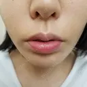 人中短縮 CLASSY 仙台美容外科・美容皮膚科 BEFORE サムネイル用