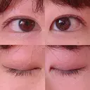 二重切開 / 上まぶたの脂肪取り 湘南美容クリニック 宇都宮院 BEFORE サムネイル用