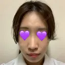 鼻尖形成（切開） / ヒアルロン酸注入（鼻） 東京ヒルズクリニック 新宿院 BEFORE サムネイル用