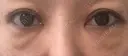 下まぶたたるみ取り セオリークリニック BEFORE サムネイル用
