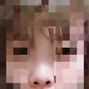鼻尖形成（切開） / 小鼻縮小（切開） / 軟骨移植 / 眉間プロテーゼ 湘南美容クリニック 広島院 BEFORE サムネイル用