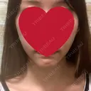 骨切り（あご） / 骨削り（エラ） / 脂肪注入（輪郭） RG整形外科（旧リオン整形外科） BEFORE サムネイル用