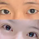 二重埋没 湘南美容クリニック 熊本院 BEFORE サムネイル用