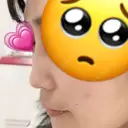 隆鼻術 たにまちクリニック BEFORE サムネイル用