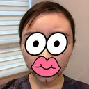 糸リフト / 骨削り（頬） / 脂肪吸引（顔） RG整形外科（旧リオン整形外科） BEFORE サムネイル用