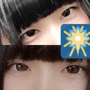 二重埋没 共立美容外科 大分院 BEFORE サムネイル用