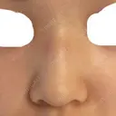 隆鼻術 / 鼻尖形成（切開） / 小鼻縮小（切開） / 軟骨移植 / 骨切幅寄せ / ワシ鼻修正・ハンプ切除 ザ・プラス美容外科 BEFORE サムネイル用