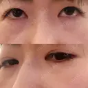 下まぶたの脂肪取り 品川美容外科 渋谷院（※品川スキンクリニック提携） BEFORE サムネイル用