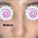 鼻修正 たにまちクリニック BEFORE サムネイル用