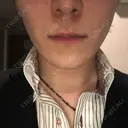 エレクトロポレーション 湘南美容クリニック 秋葉原院 BEFORE サムネイル用