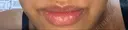 人中短縮 / 口角挙上 / その他（口元） 清潭女神美容外科 BEFORE サムネイル用