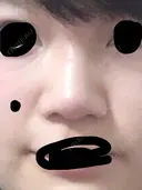 鼻尖形成（切開） 三輪皮フ科形成外科 BEFORE サムネイル用