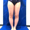 脂肪吸引（脚） / 豊胸（脂肪注入） 水の森美容クリニック 東京新宿院 BEFORE サムネイル用