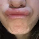 ボトックス（あご） TCB東京中央美容外科 京都駅前院 BEFORE サムネイル用