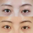 二重切開 / 眼瞼下垂（切開） / 目尻切開 / 上まぶたの脂肪取り / タレ目形成・グラマラスライン（切開） id（アイディ）美容外科 BEFORE サムネイル用