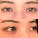 眼瞼下垂（切開） / 目尻切開 / タレ目形成・グラマラスライン（切開） プロミス整形外科 BEFORE サムネイル用
