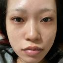 目頭切開 / 鼻尖形成（切開） / 額を丸く / 目尻切開 / 上まぶたの脂肪取り / 軟骨移植 / 脂肪注入（輪郭） TN整形外科 BEFORE サムネイル用