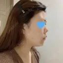鼻中隔延長（切開） / 軟骨移植 / 眉間プロテーゼ FROM B整形外科 (旧バウム整形外科) BEFORE サムネイル用