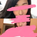 二重埋没 / 隆鼻術 共立美容外科 名古屋院 BEFORE サムネイル用