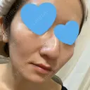 骨削り（頬） RG整形外科（旧リオン整形外科） BEFORE サムネイル用