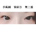 二重切開 / 目頭切開 / 上まぶたたるみ取り 湘南美容クリニック 金沢院 BEFORE サムネイル用