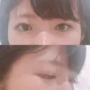 脂肪溶解注射（まぶた） 銀座フェイスクリニック（小顔整形・輪郭整形專門） BEFORE サムネイル用