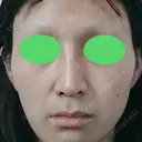 骨切り（あご） / 骨削り（エラ） / 骨削り（頬） / ルフォー+ssro（両あご) id（アイディ）美容外科 BEFORE サムネイル用