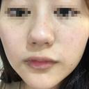 ピコレーザートーニング（美白・肝斑） UB CLINIC 銀座 BEFORE サムネイル用